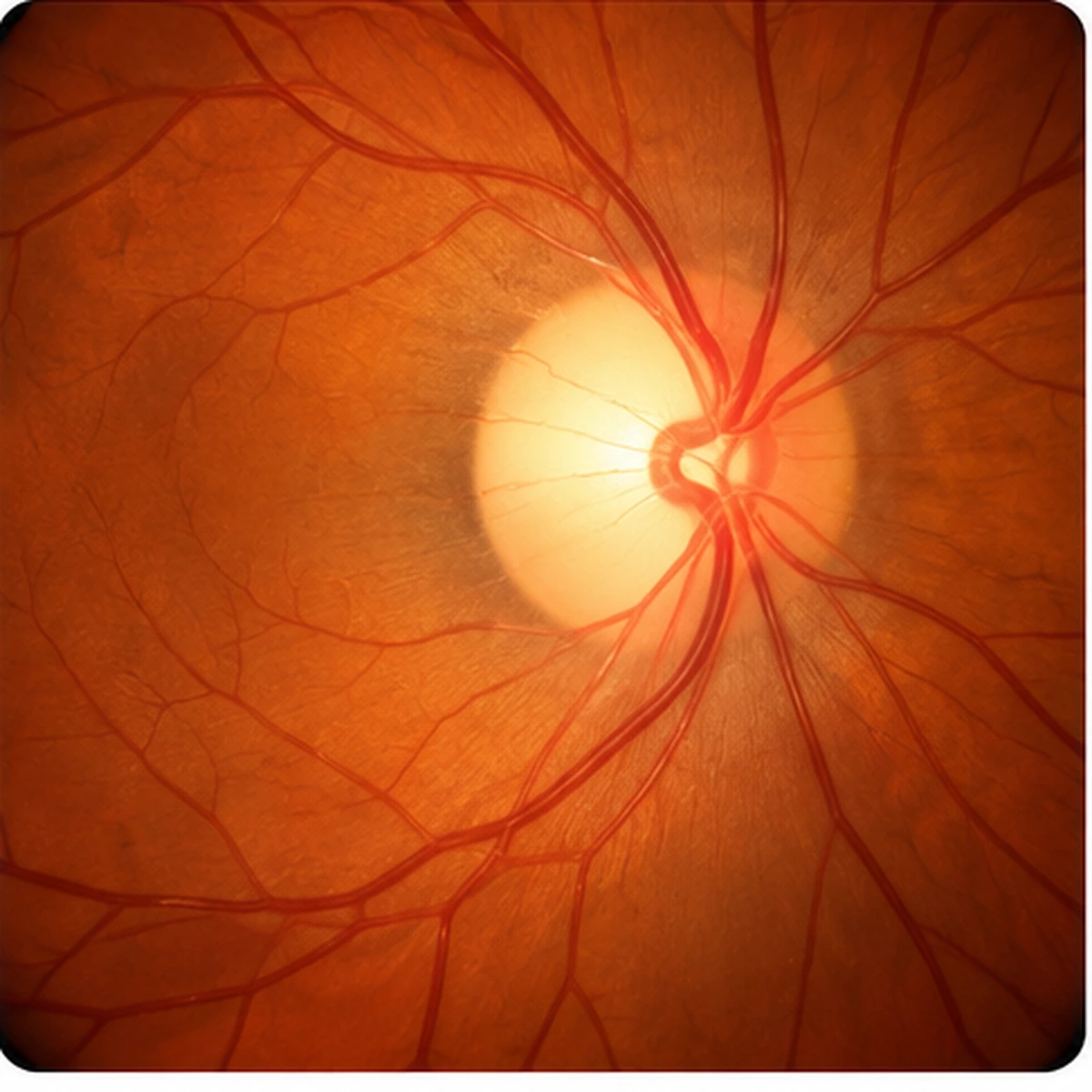 Glaucoma